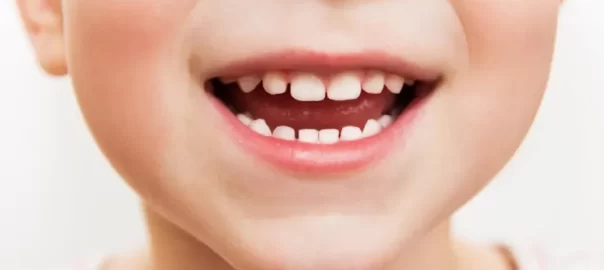 Teeth Whitening For Kids Carlsbad